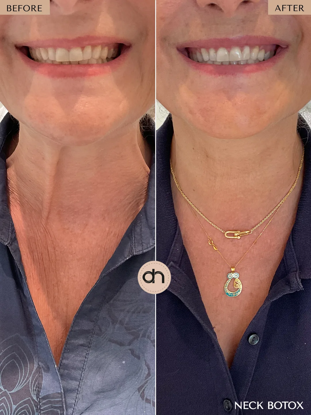 Expression Lines before and after by Dr. Nivine Cheaito
