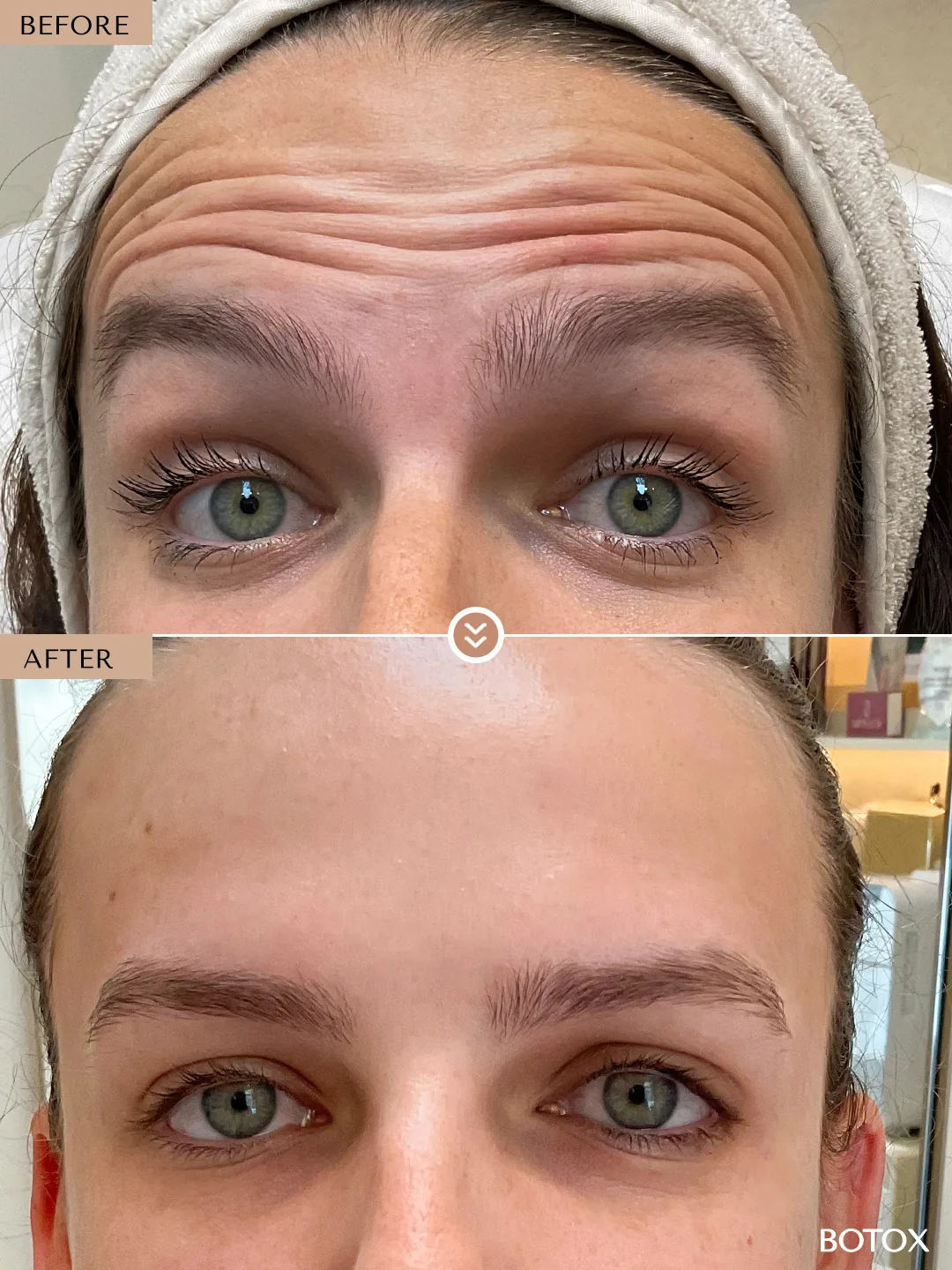 Expression Lines before and after by Dr. Nivine Cheaito