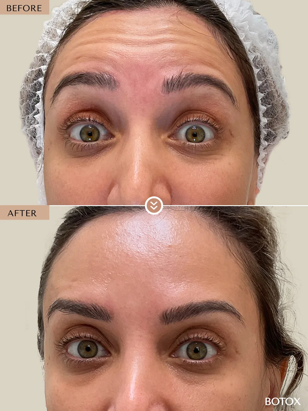Expression Lines before and after by Dr. Nivine Cheaito
