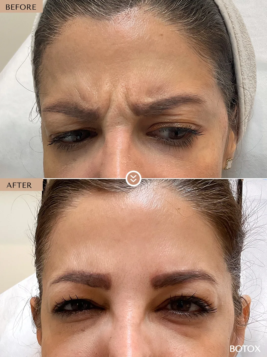 Expression Lines before and after by Dr. Nivine Cheaito