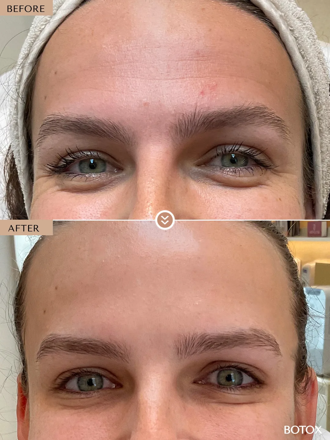 Expression Lines before and after by Dr. Nivine Cheaito
