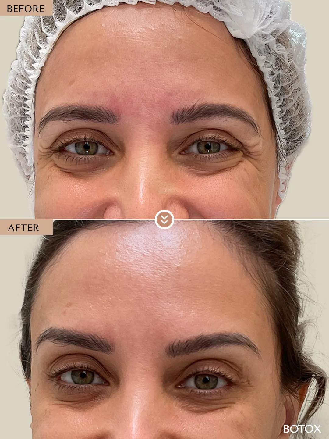 Expression Lines before and after by Dr. Nivine Cheaito