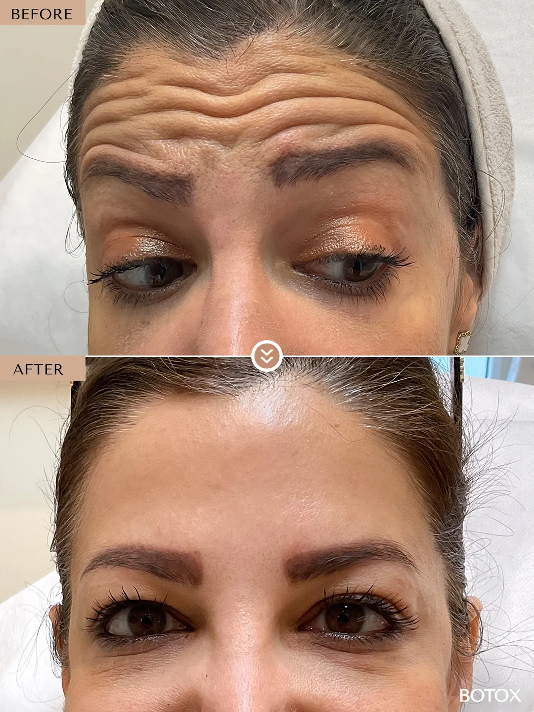 Frown Lines before and after by Dr. Nivine Cheaito