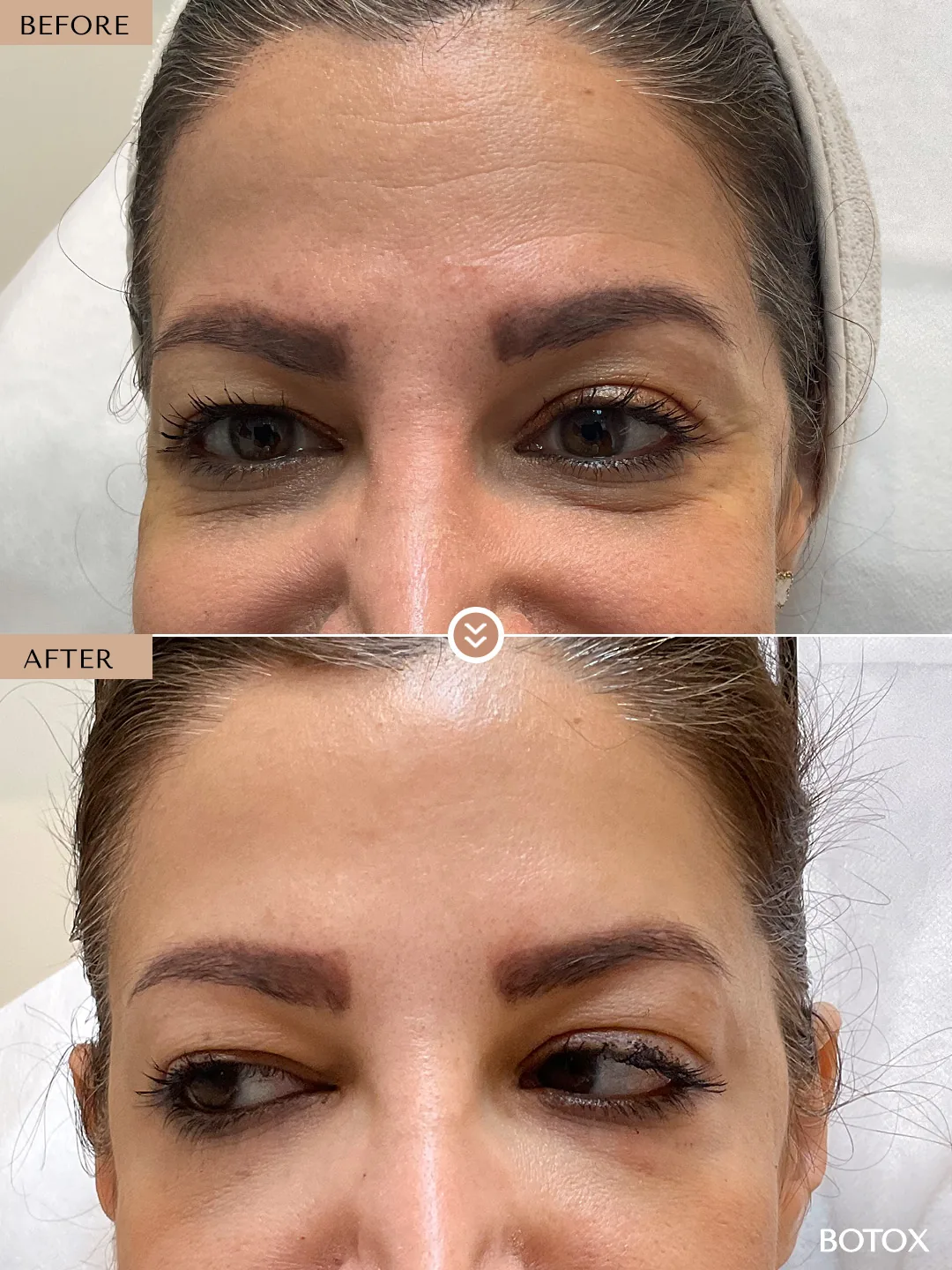 Lines Around the Eyes before and after by Dr. Nivine Cheaito