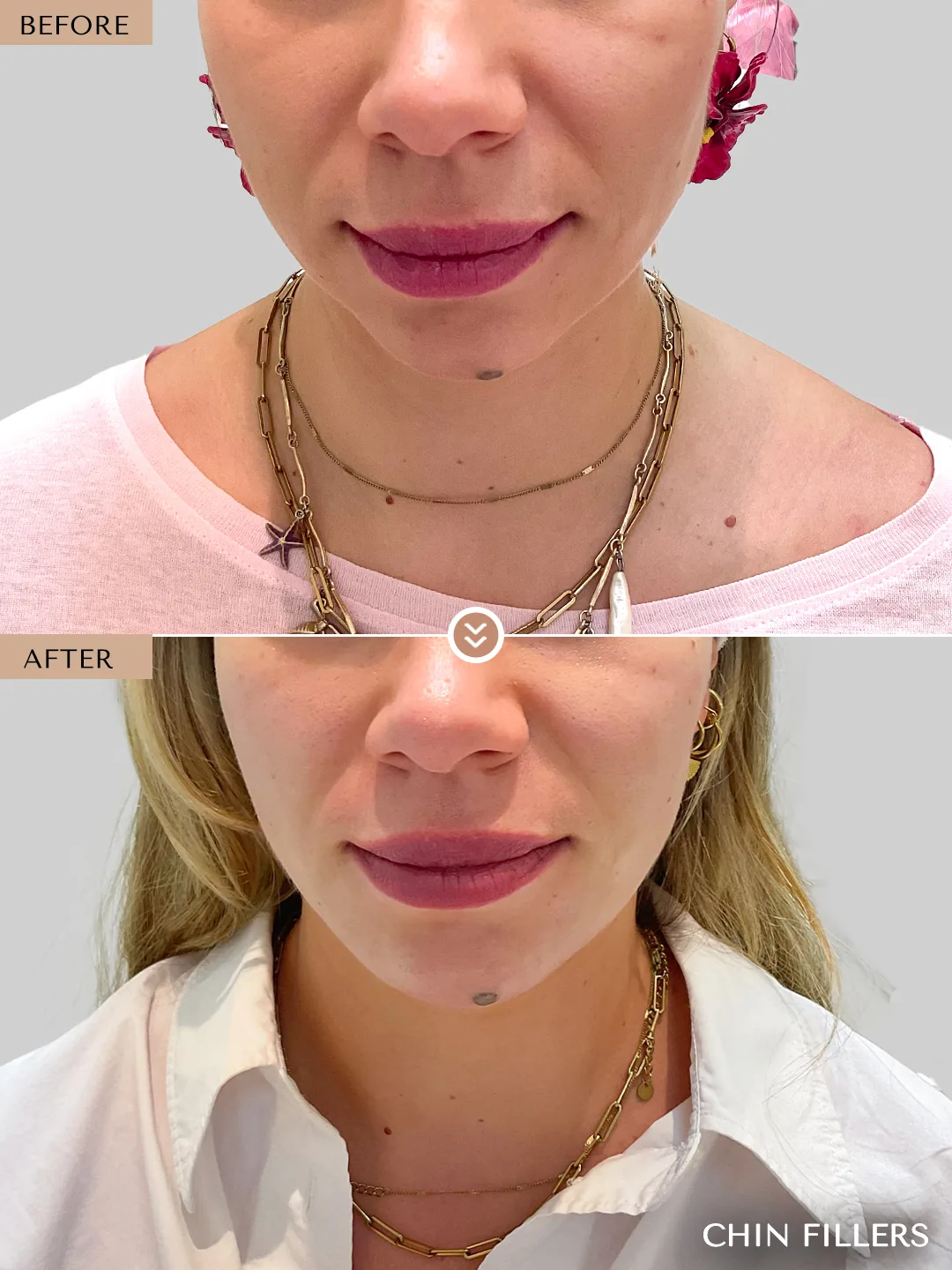 Lip and chin balance before and after by Dr. Nivine Cheaito
