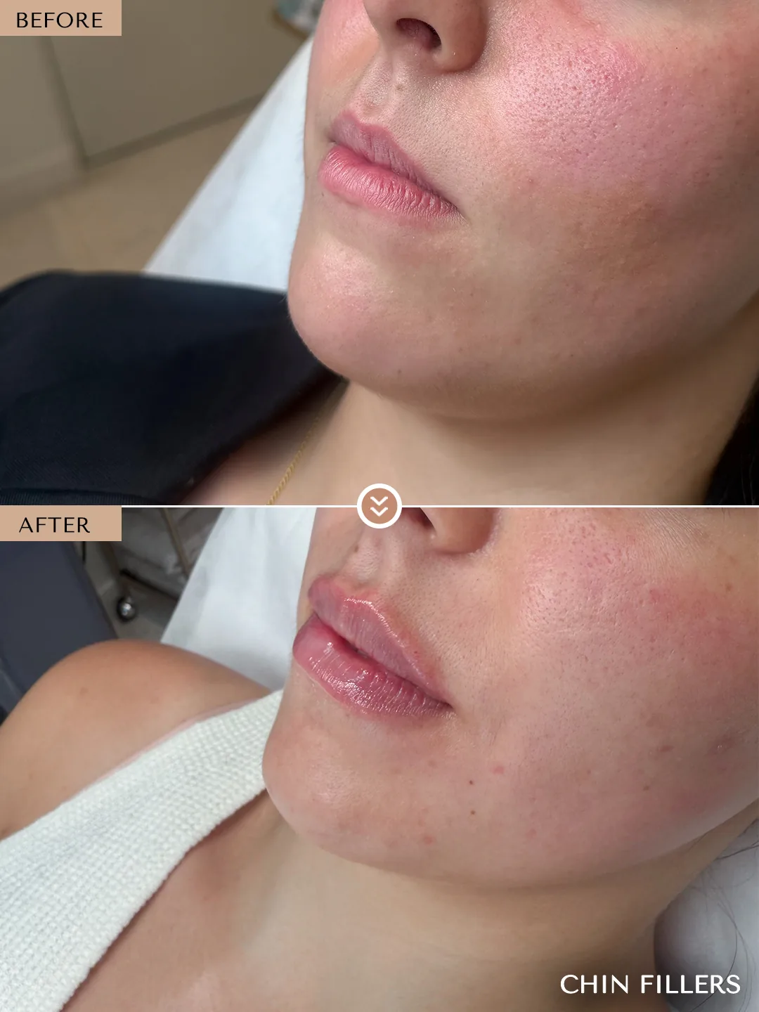 Chin & Jawline before and after by Dr. Nivine Cheaito