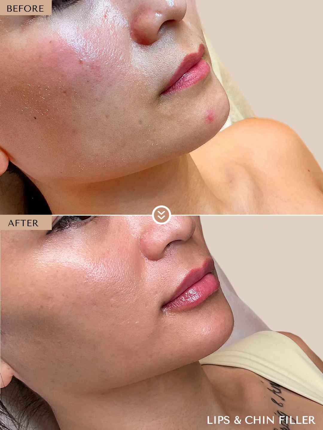 Chin & Jawline before and after by Dr. Nivine Cheaito