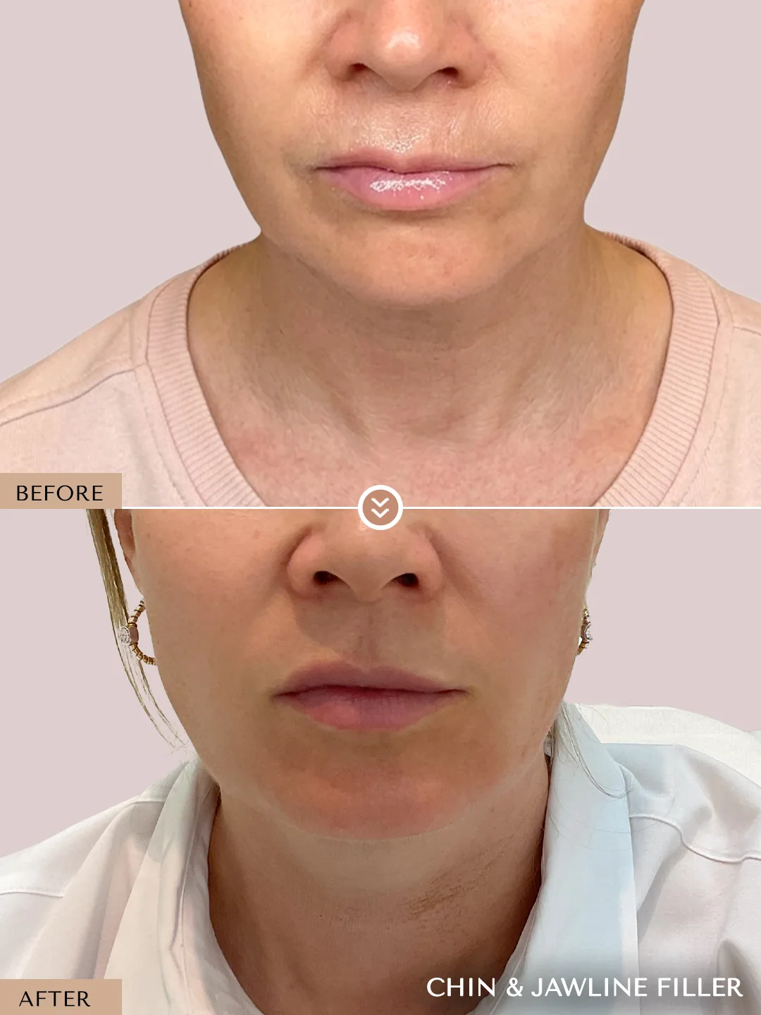 Chin Definition before and after by Dr. Nivine Cheaito