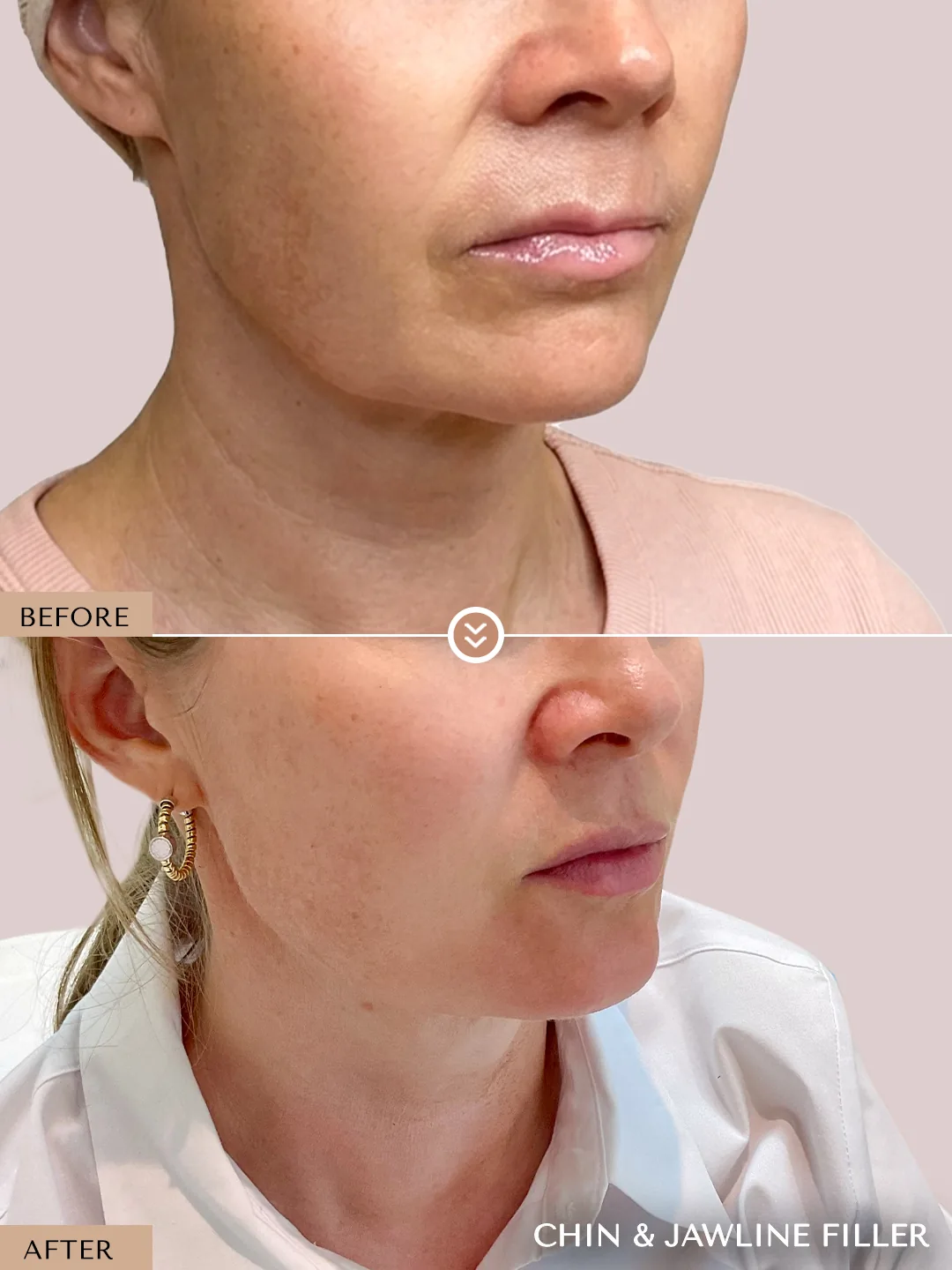Chin Definition before and after by Dr. Nivine Cheaito