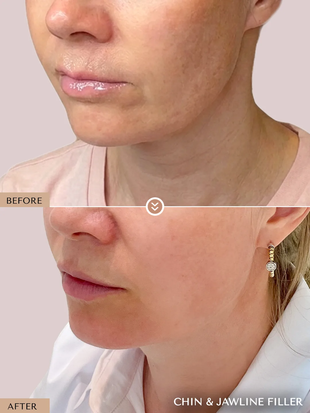 Lower Face Enhancement before and after by Dr. Nivine Cheaito