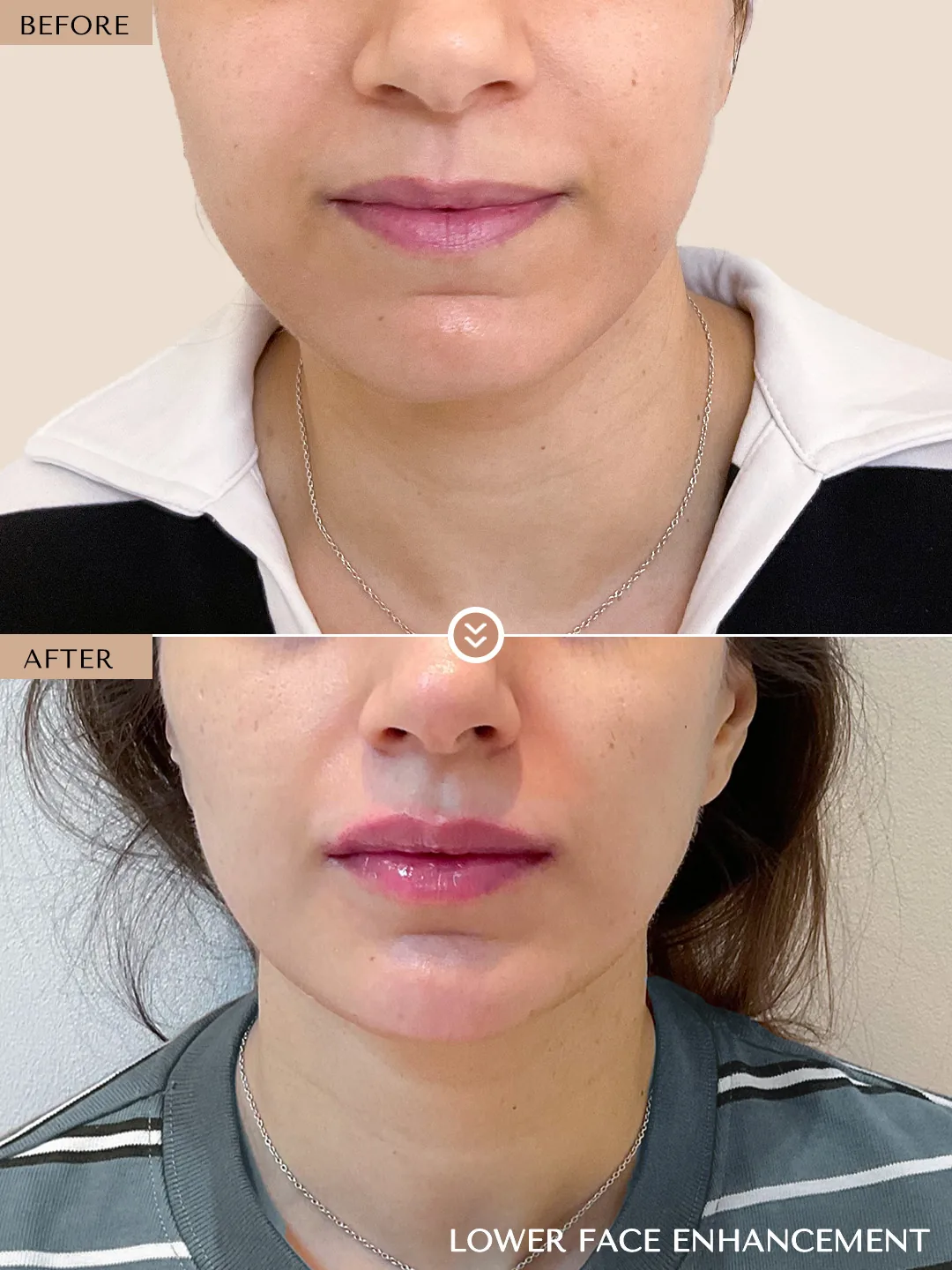 Lower Face Enhancement before and after by Dr. Nivine Cheaito