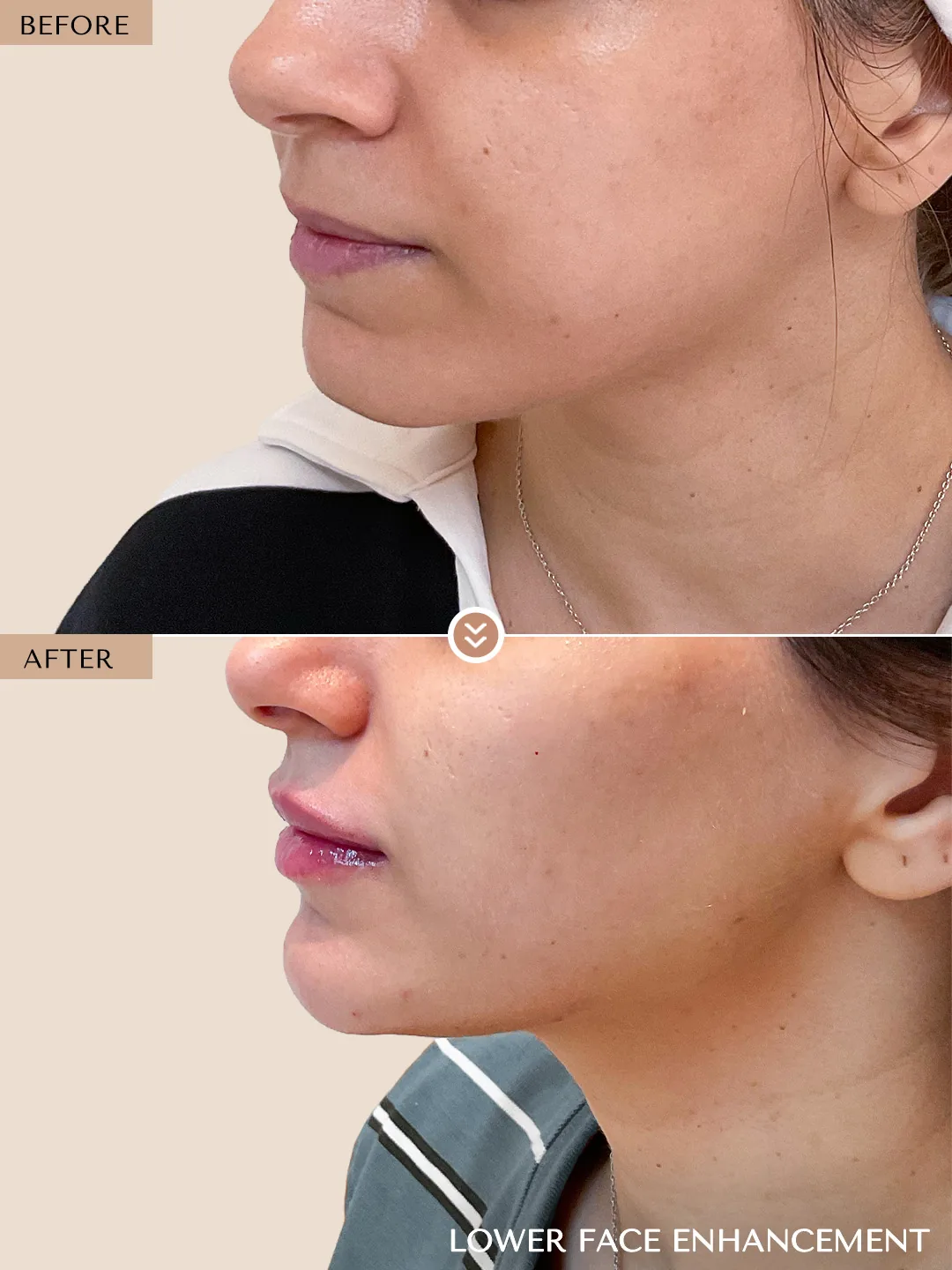 Lips & Chin before and after by Dr. Nivine Cheaito