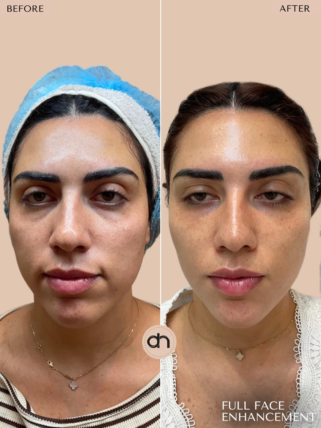 Neck Bands before and after by Dr. Nivine Cheaito