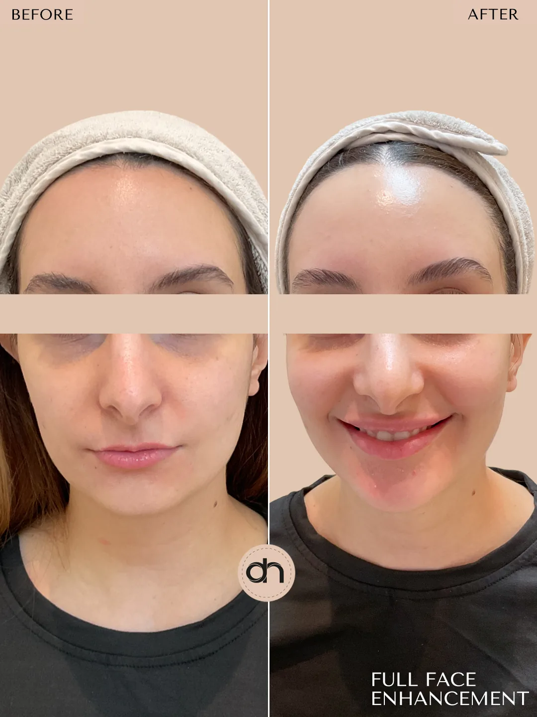 Collagen Stimulation & Lifting before and after by Dr. Nivine Cheaito