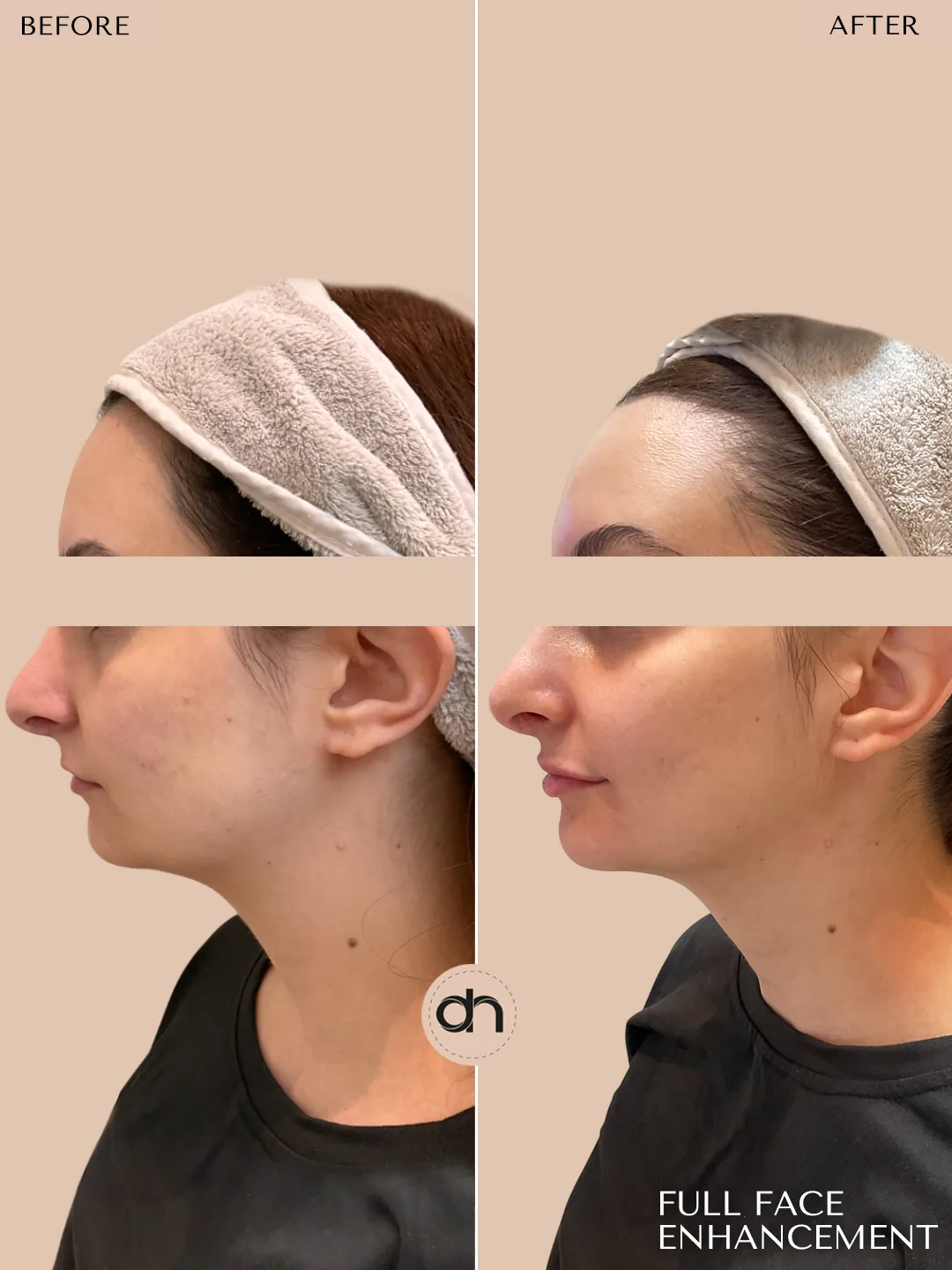 Collagen Stimulation & Lifting before and after by Dr. Nivine Cheaito
