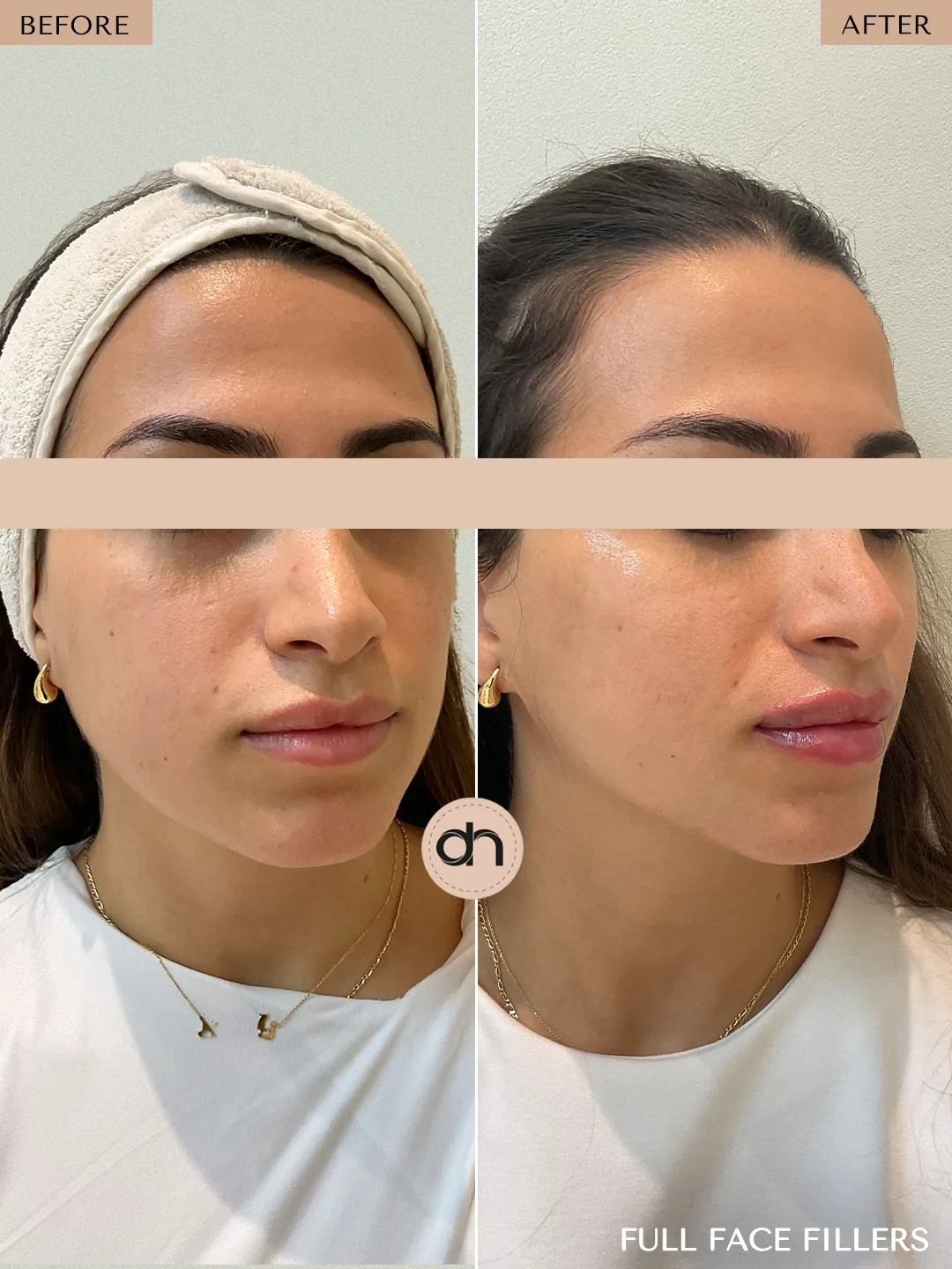 Non-Surgical Lifting before and after by Dr. Nivine Cheaito