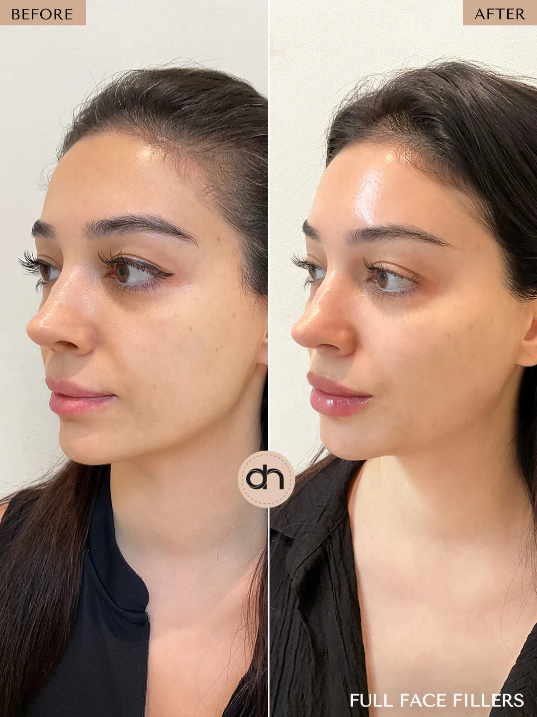 Non-Surgical Lifting before and after by Dr. Nivine Cheaito