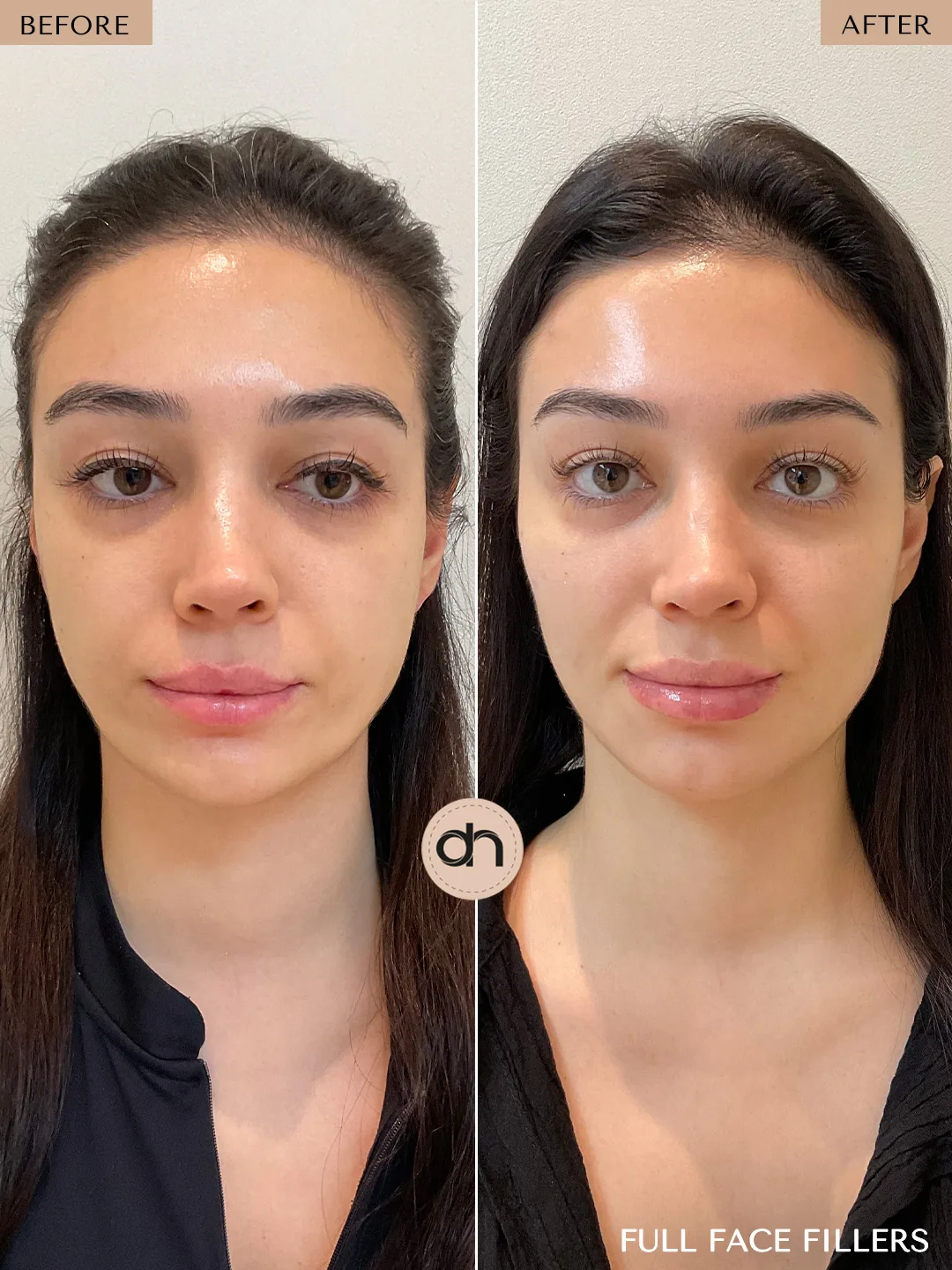 Non-Surgical Lifting before and after by Dr. Nivine Cheaito