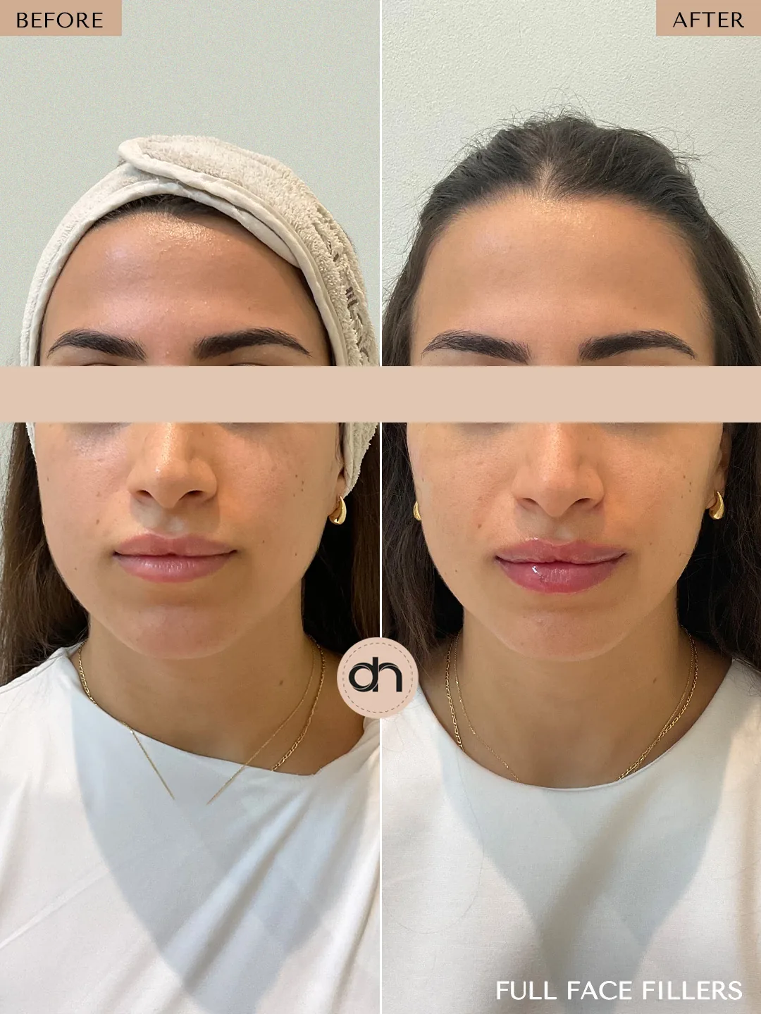 Neck Rejuvenation before and after by Dr. Nivine Cheaito