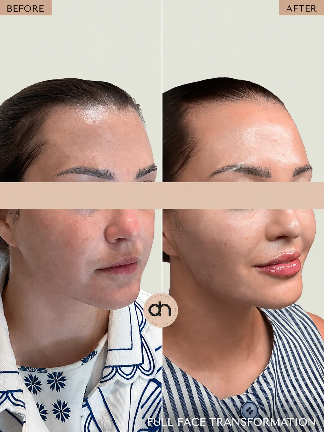 Neck Rejuvenation before and after by Dr. Nivine Cheaito