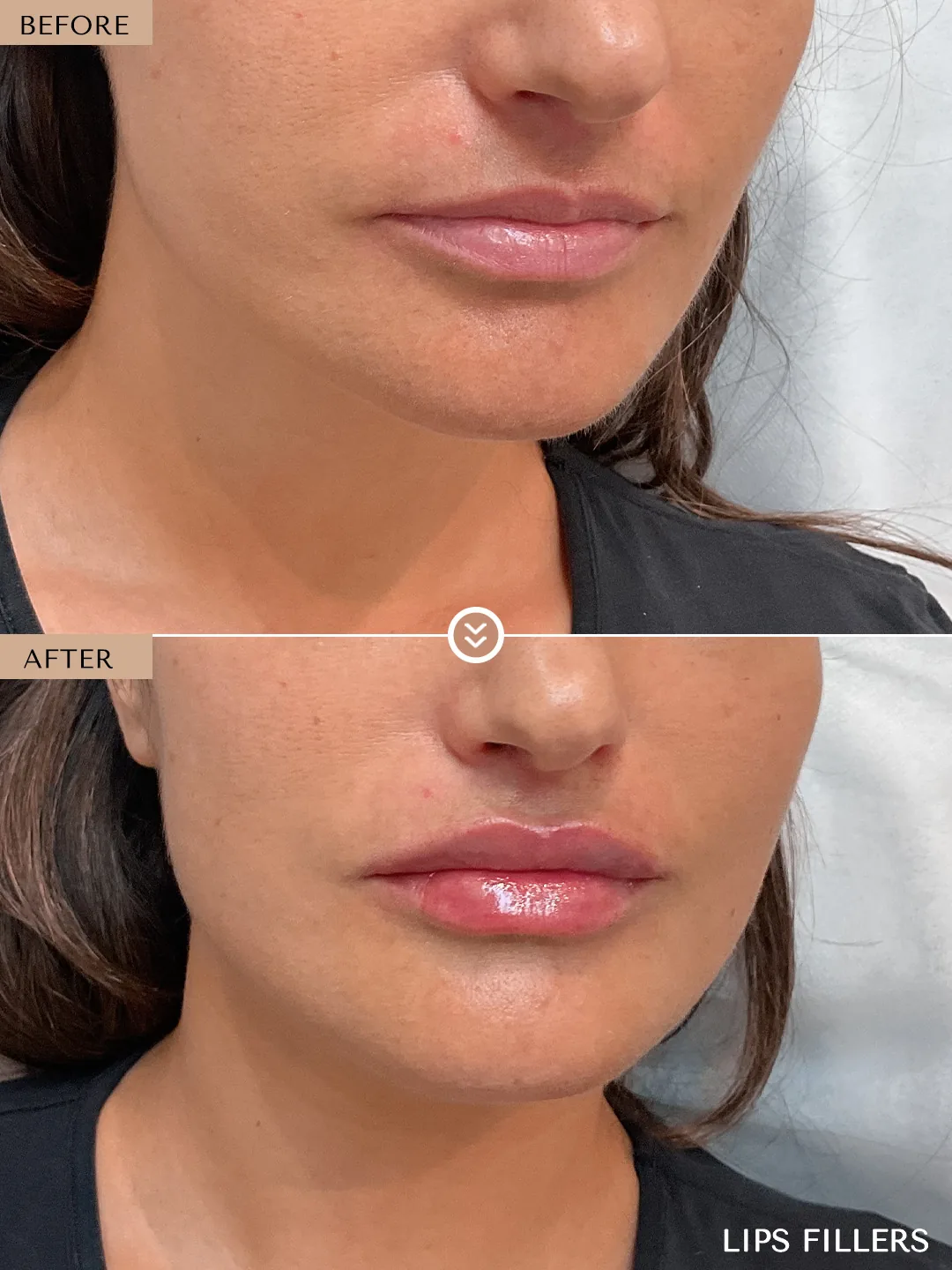 Lip enhancement before and after by Dr. Nivine Cheaito