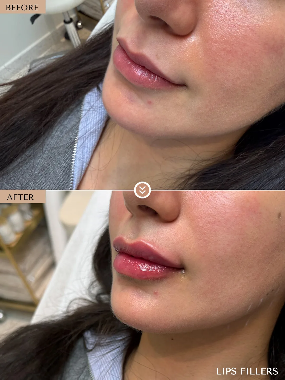 Lip shape refinement before and after by Dr. Nivine Cheaito