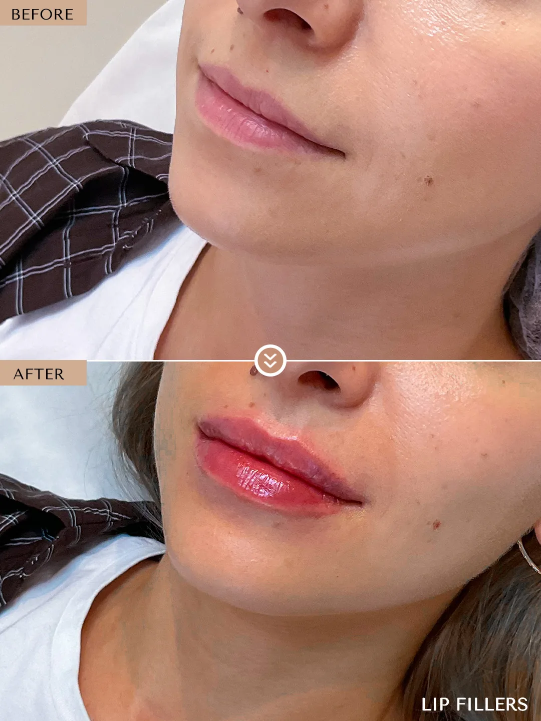 Natural lip enhancement before and after by Dr. Nivine Cheaito