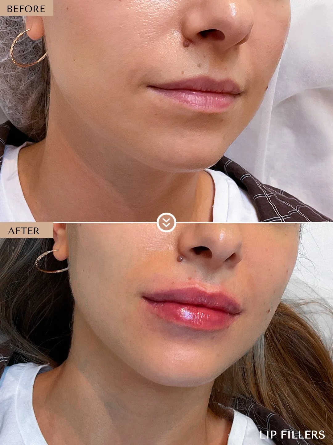 Lip border definition before and after by Dr. Nivine Cheaito