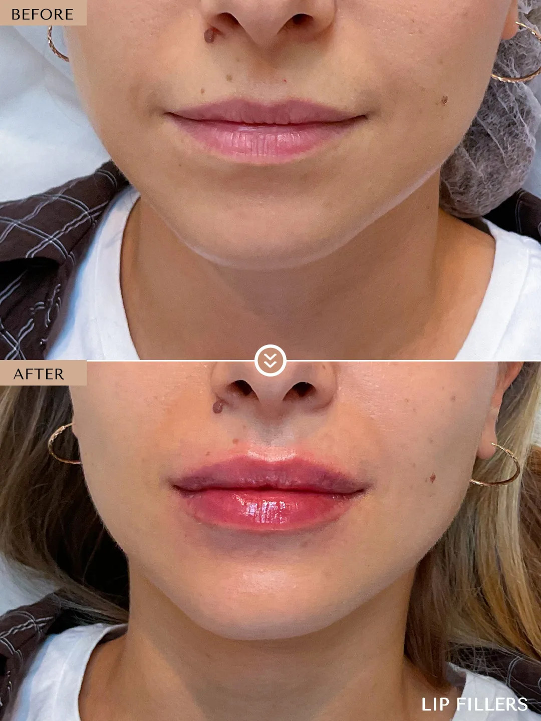 Lip balance before and after by Dr. Nivine Cheaito