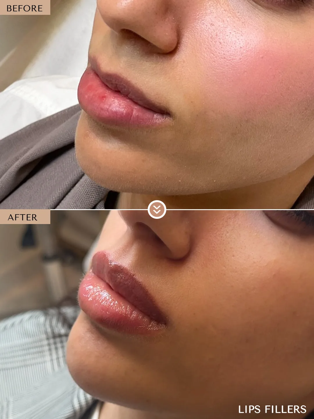 Lips case treated by Dr. Nivine Cheaito, Dubai