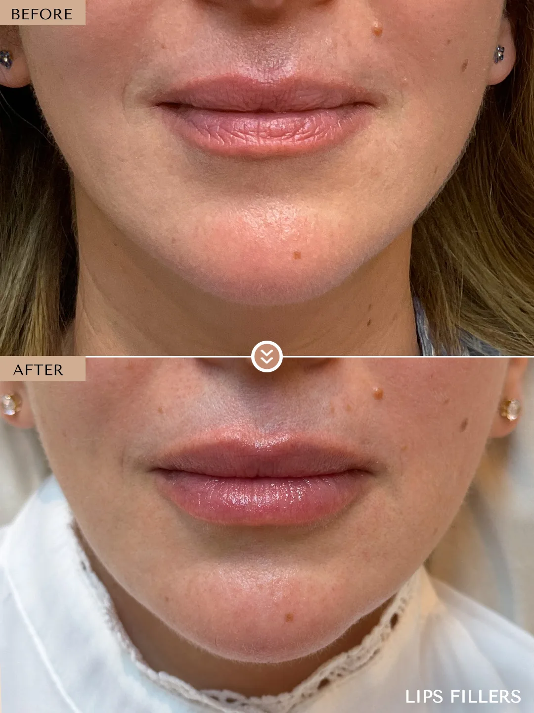 Lips case treated by Dr. Nivine Cheaito, Dubai