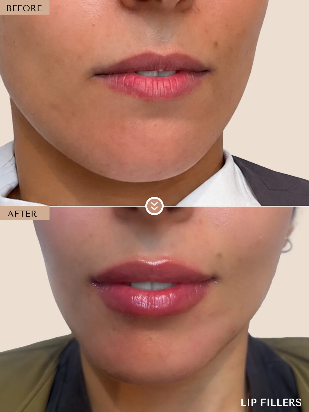 Lips case treated by Dr. Nivine Cheaito, Dubai