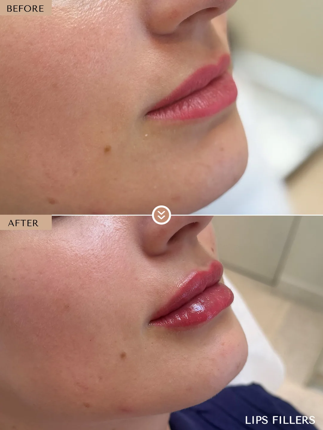 The best work doesn’t announce itself. before and after, case 9, treated by Dr. Nivine Cheaito