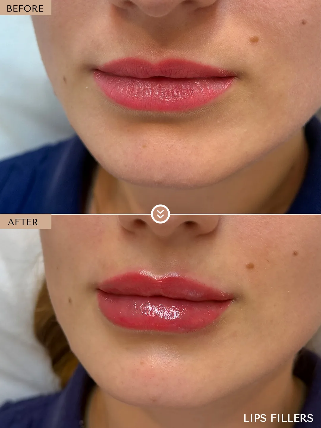 The best work doesn’t announce itself. before and after, case 10, treated by Dr. Nivine Cheaito