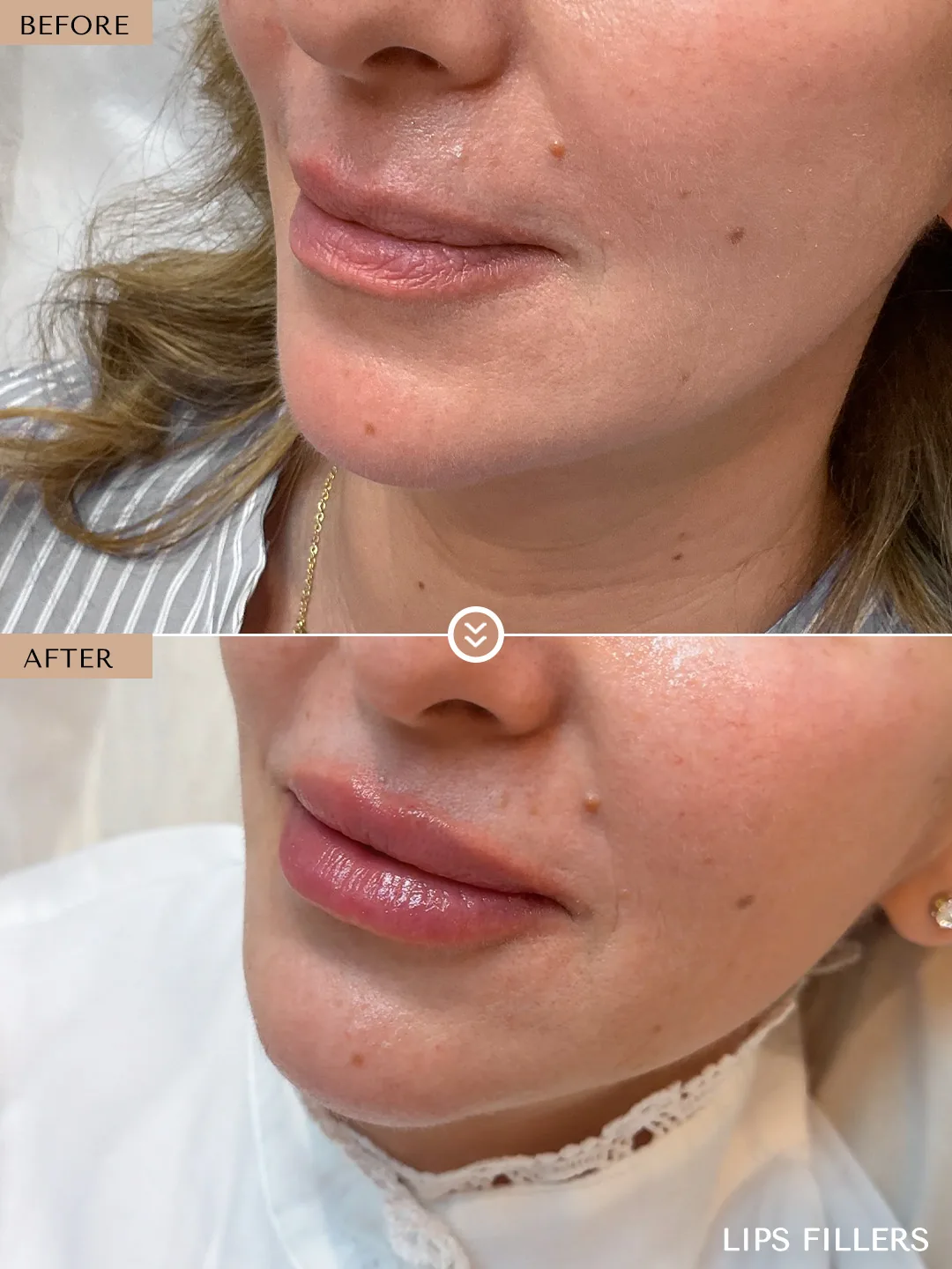 The best work doesn’t announce itself. before and after, case 11, treated by Dr. Nivine Cheaito