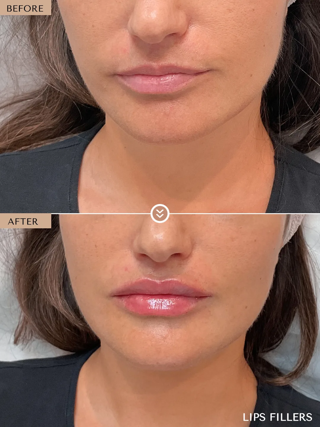 The best work doesn’t announce itself. before and after, case 12, treated by Dr. Nivine Cheaito