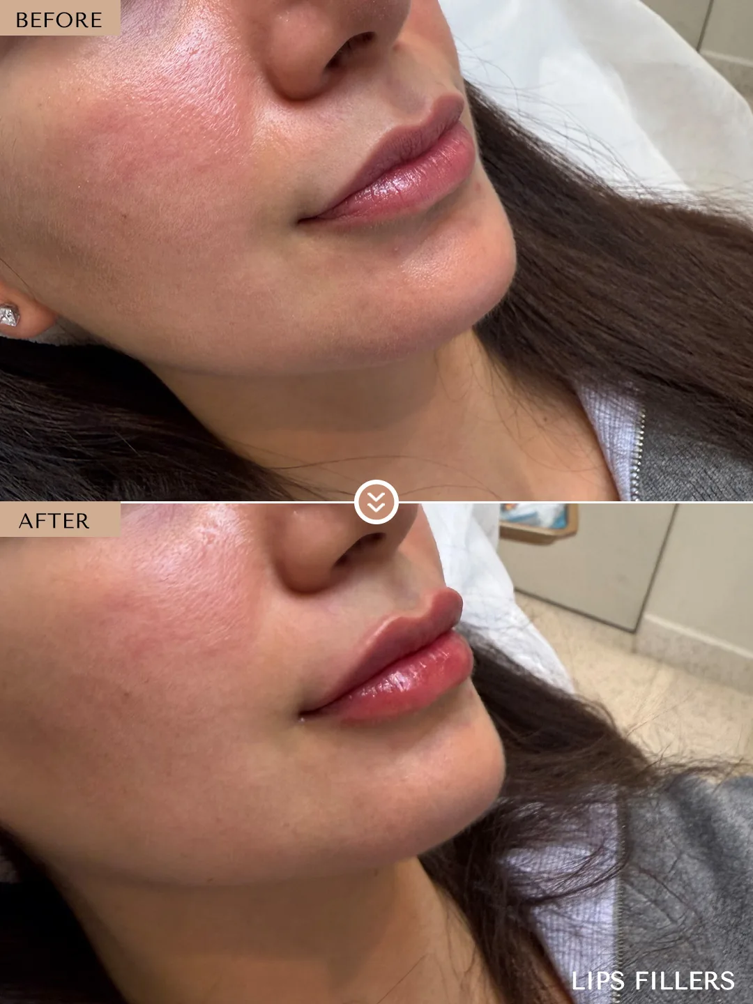 The best work doesn’t announce itself. before and after, case 13, treated by Dr. Nivine Cheaito