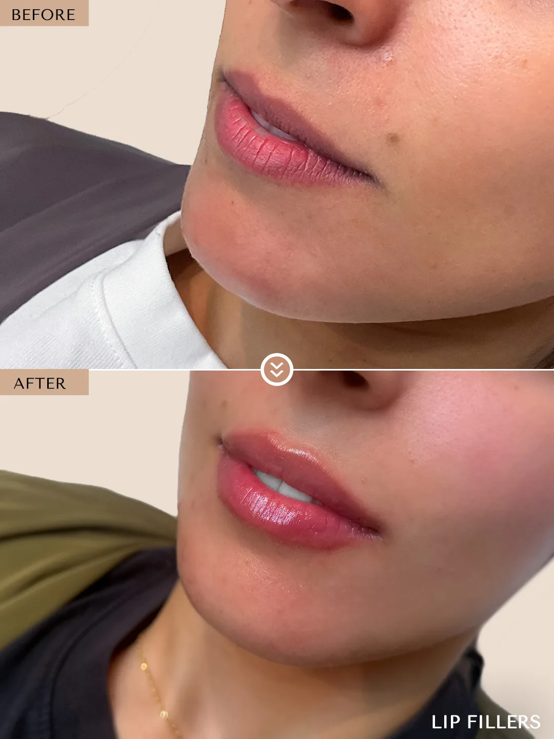 The best work doesn’t announce itself. before and after, case 14, treated by Dr. Nivine Cheaito