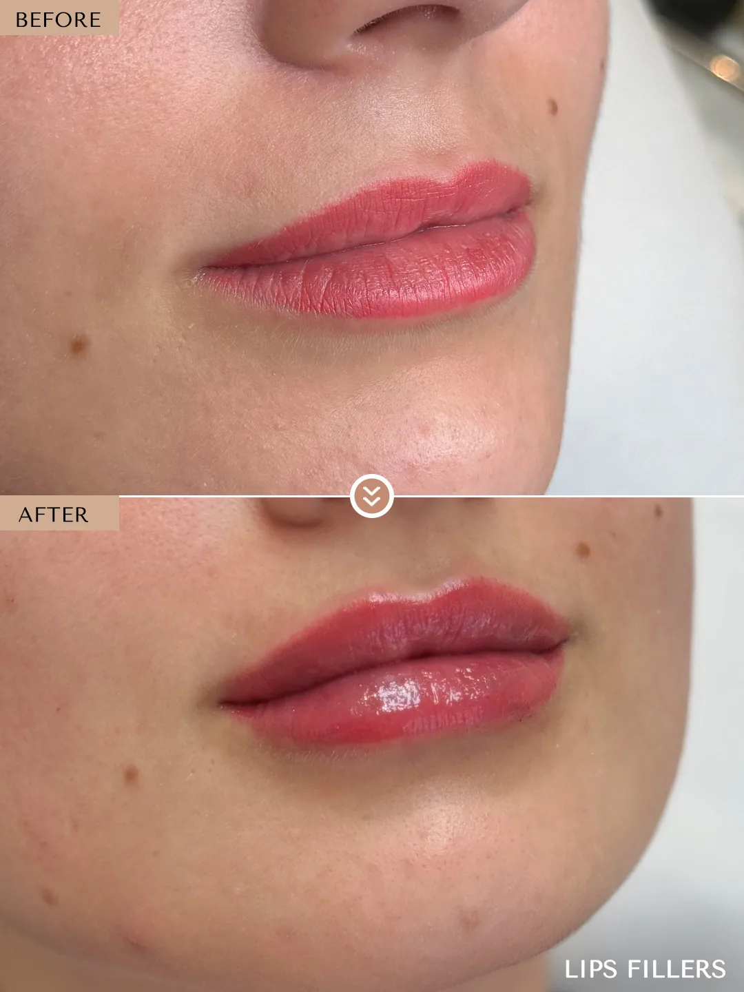 The best work doesn’t announce itself. before and after, case 15, treated by Dr. Nivine Cheaito