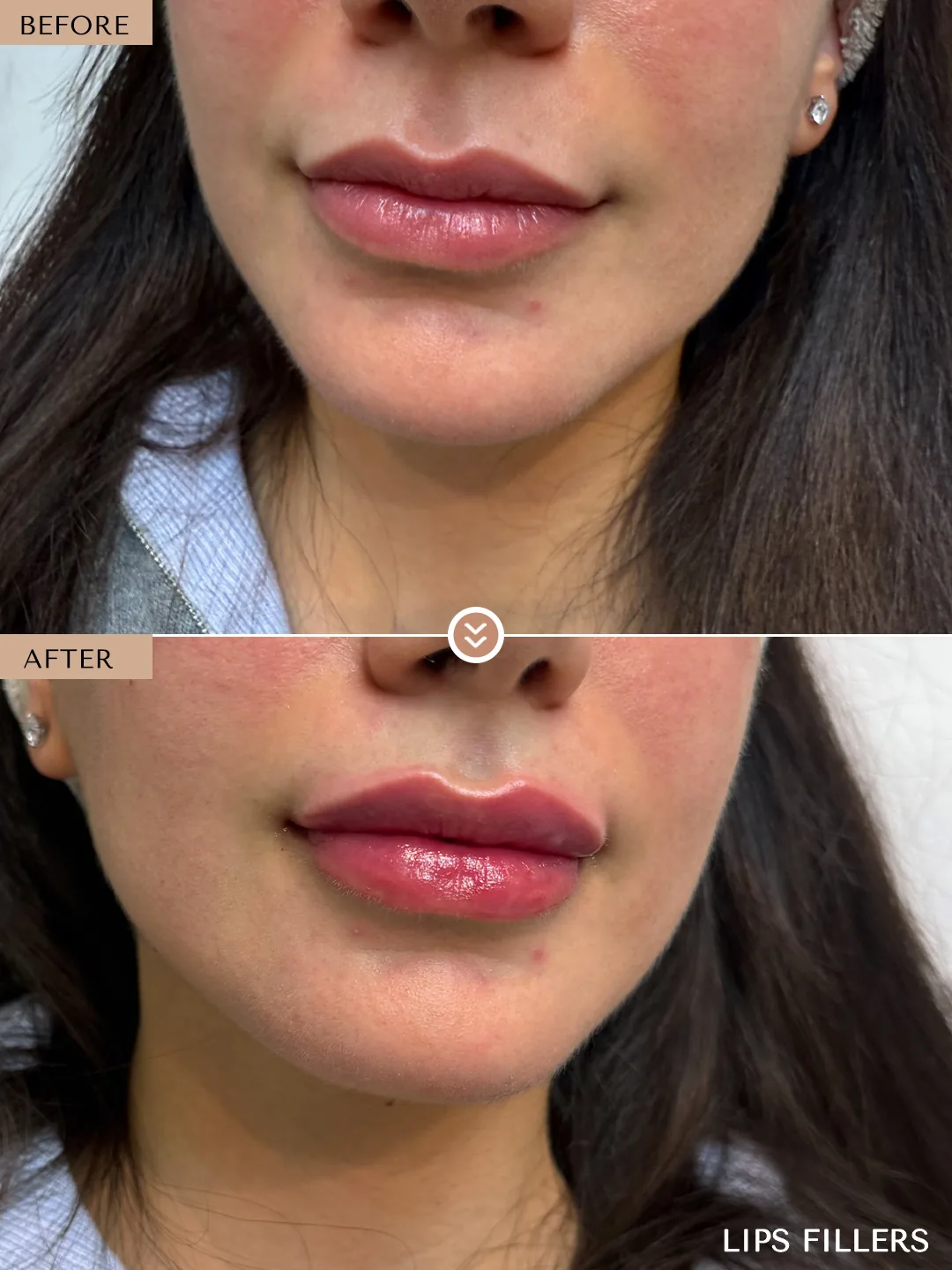 The best work doesn’t announce itself. before and after, case 16, treated by Dr. Nivine Cheaito