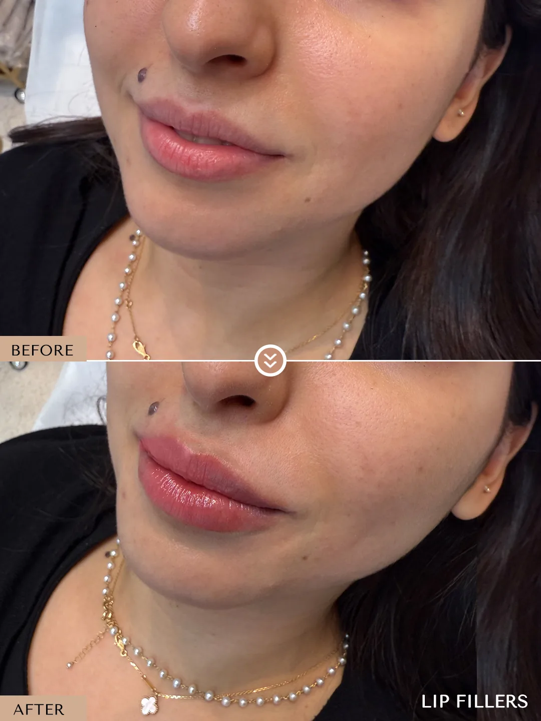 The best work doesn’t announce itself. before and after, case 17, treated by Dr. Nivine Cheaito