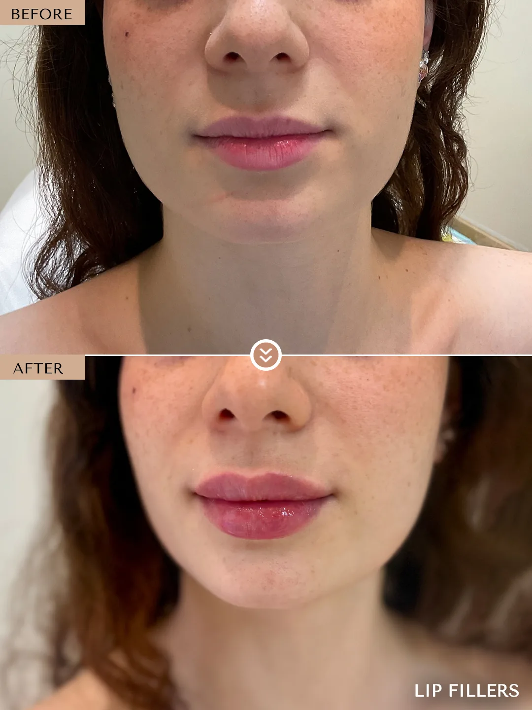 The best work doesn’t announce itself. before and after, case 18, treated by Dr. Nivine Cheaito