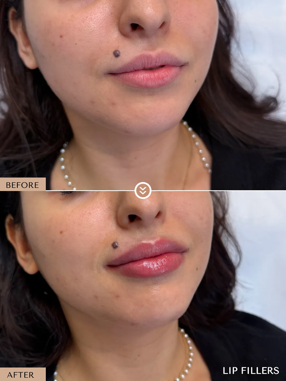 The best work doesn’t announce itself. before and after, case 19, treated by Dr. Nivine Cheaito