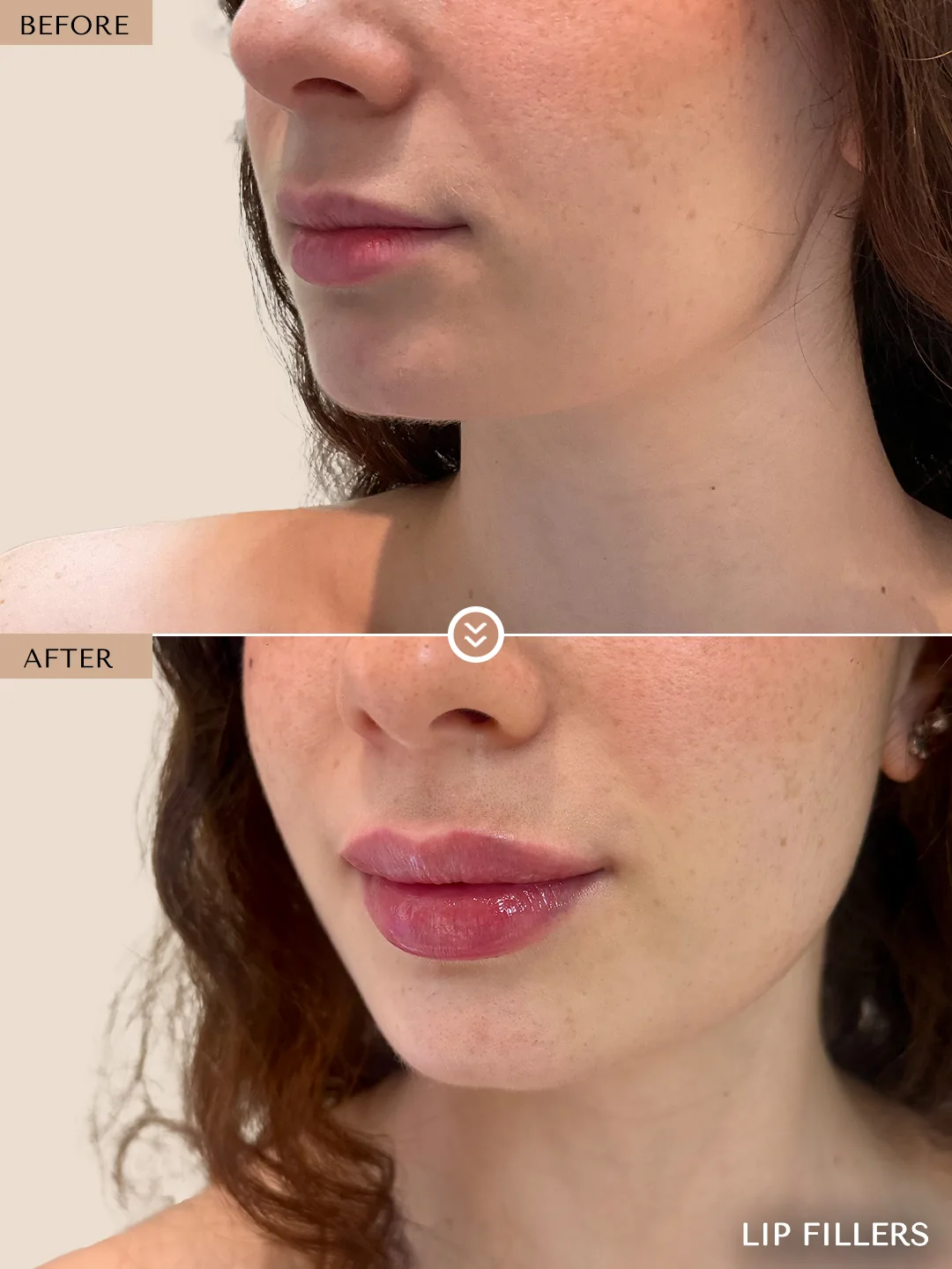 The best work doesn’t announce itself. before and after, case 20, treated by Dr. Nivine Cheaito