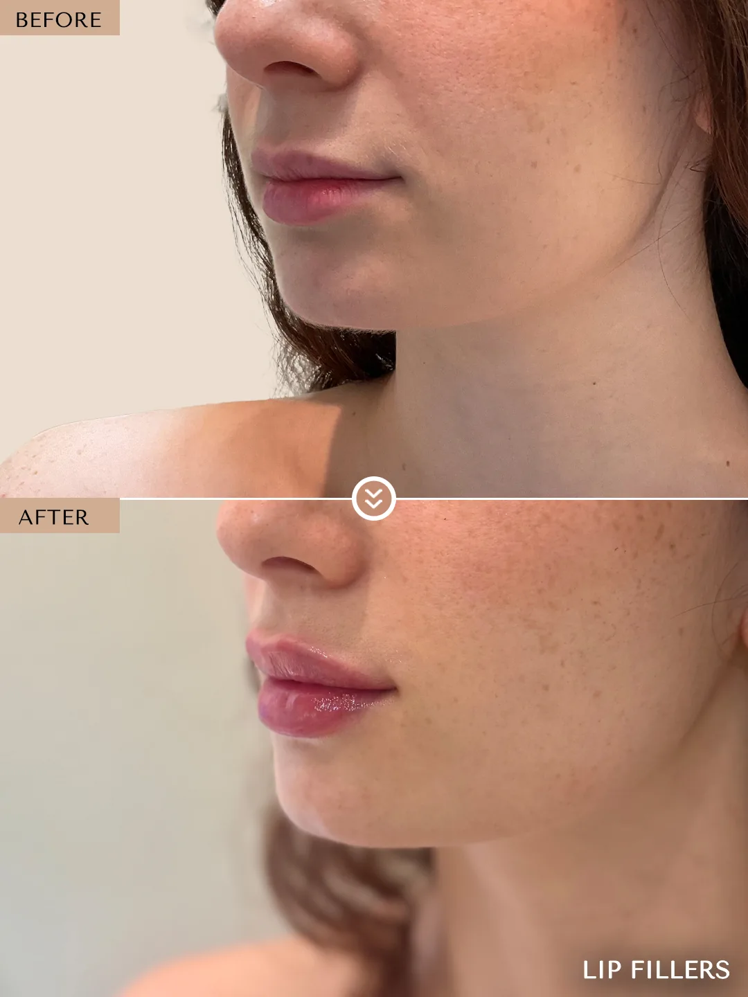 The best work doesn’t announce itself. before and after, case 21, treated by Dr. Nivine Cheaito