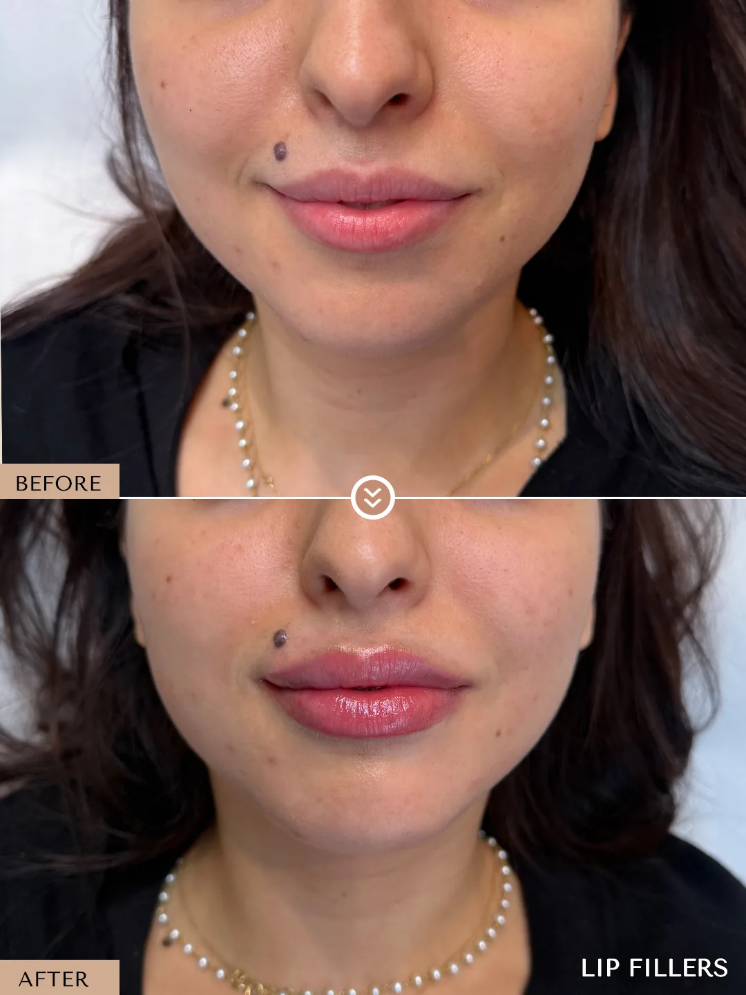 The best work doesn’t announce itself. before and after, case 22, treated by Dr. Nivine Cheaito