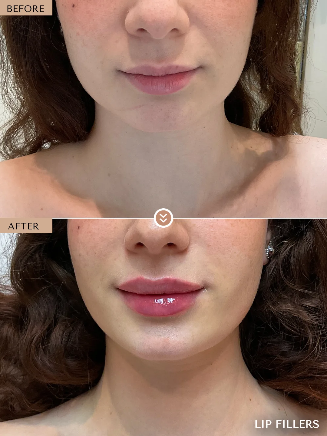 The best work doesn’t announce itself. before and after, case 23, treated by Dr. Nivine Cheaito