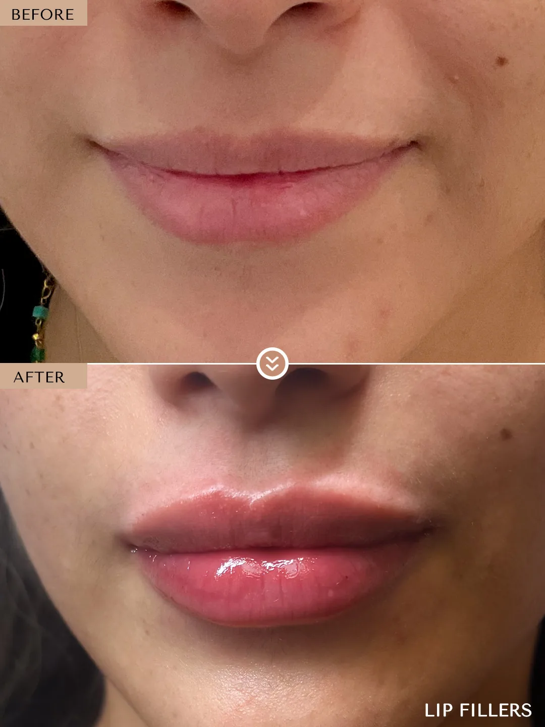 The best work doesn’t announce itself. before and after, case 24, treated by Dr. Nivine Cheaito