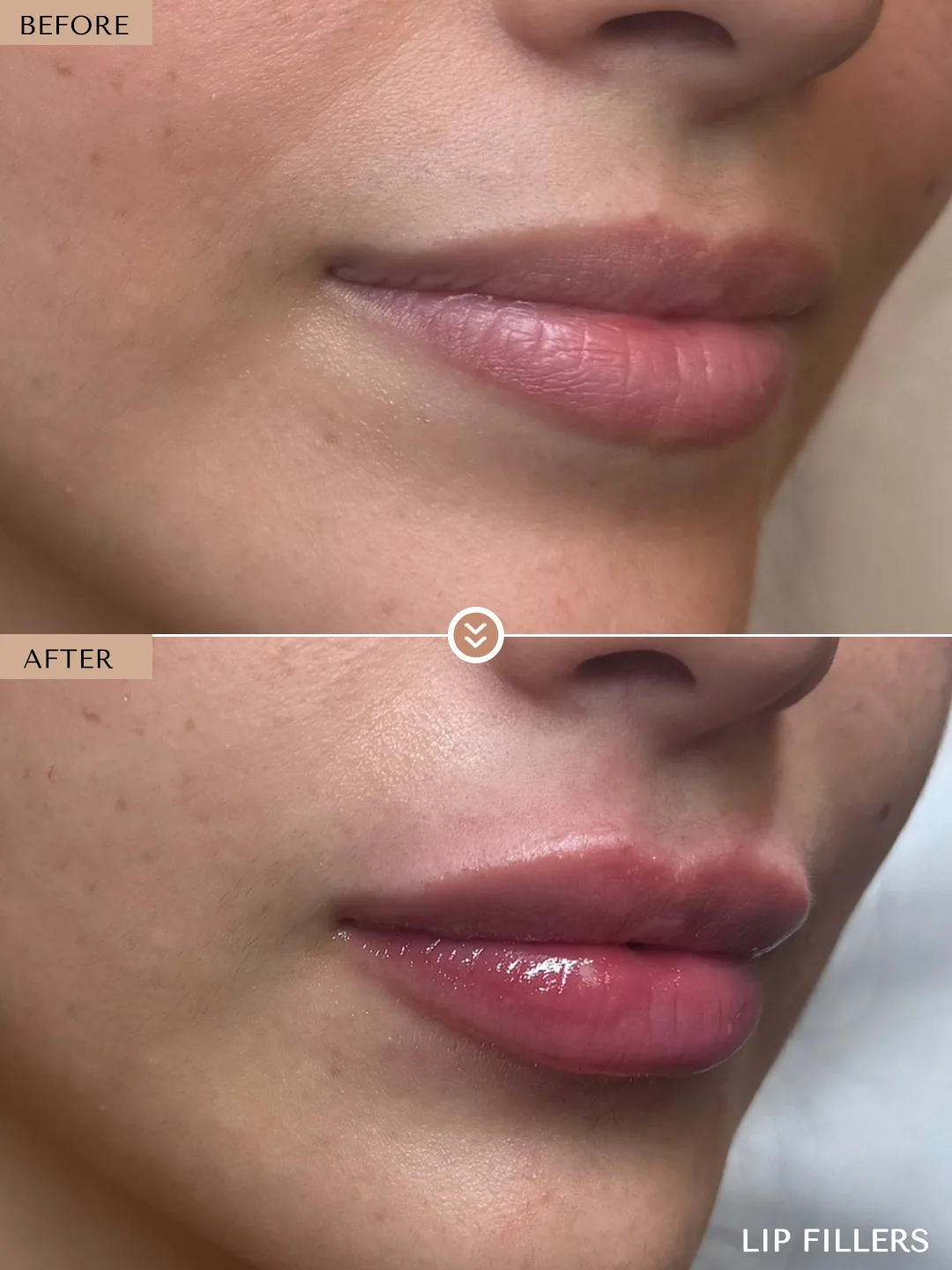 The best work doesn’t announce itself. before and after, case 25, treated by Dr. Nivine Cheaito