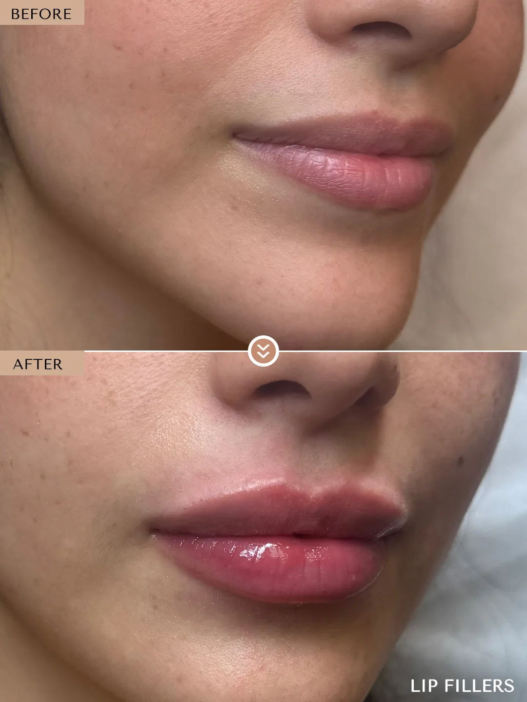 The best work doesn’t announce itself. before and after, case 26, treated by Dr. Nivine Cheaito